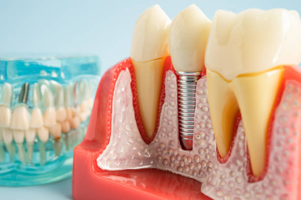 Best Dental Fillings (Composite and Amalgam)  in Sparta, MI